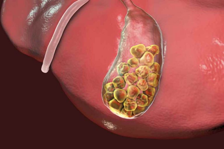 Calcoli Alla Colecisti Cosa Mangiare Sintomi E Cosa Evitare